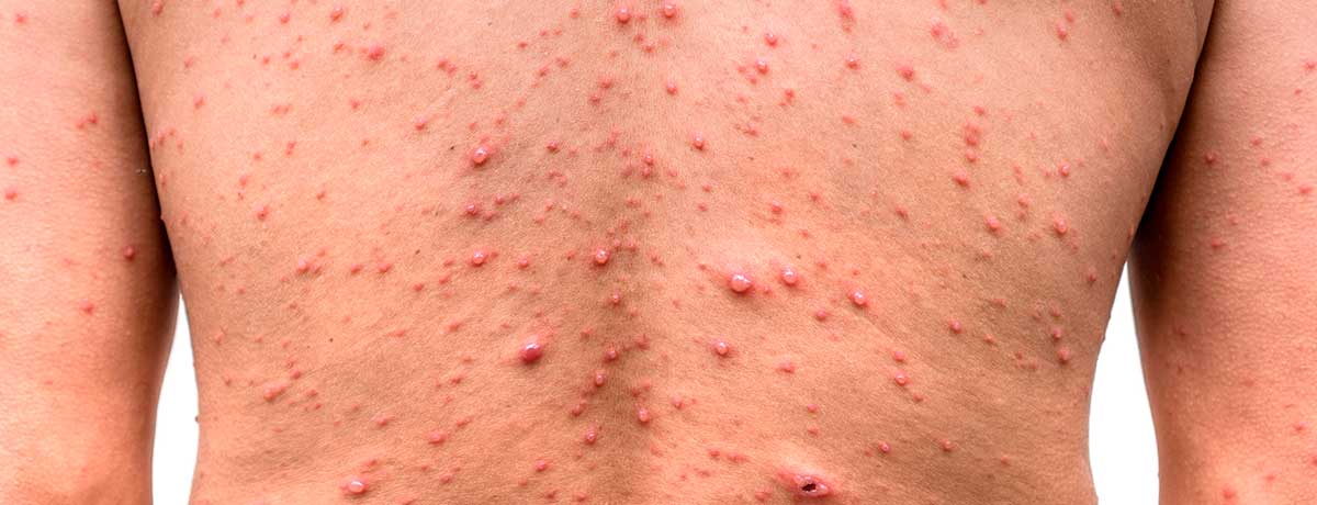 HIV rash: How to identify HIV rash and how to treat it?