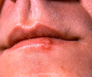 Herpes IgG Index Value Explained: Low vs High, False Positives, and What It Really Means