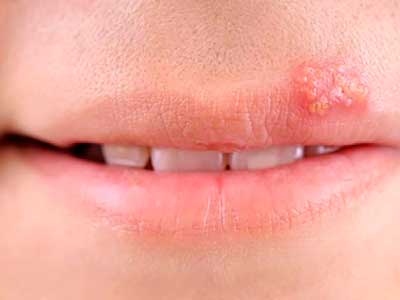 Herpes and canker sore signs: similarities and differences