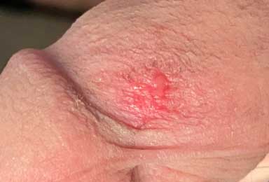 classic friction burn