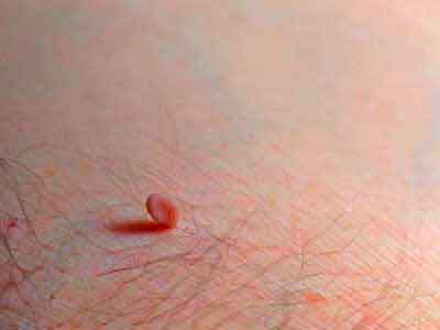 Photos of skin tags and genital warts