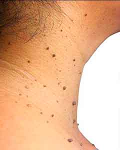 Photos of skin tags and genital warts