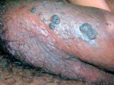 Photos of skin tags and genital warts