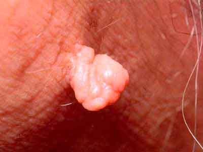 Photos of skin tags and genital warts